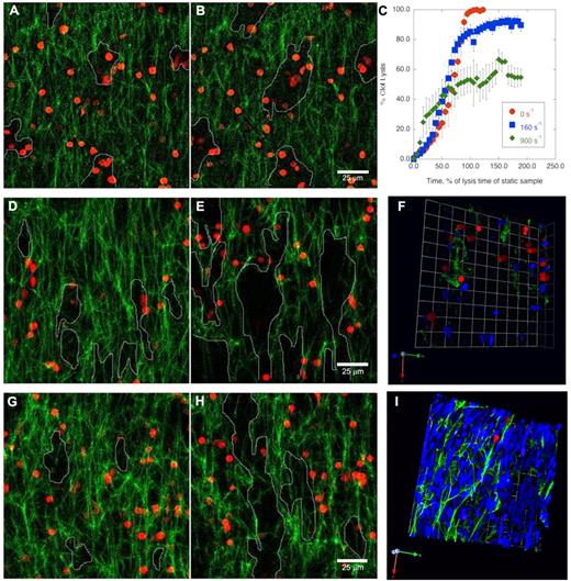 Figure 1. Shear stress changes the mechanism of prophylactic thrombolysis by incorporated RBC-PAs from multilateral lysis to formation of flow-directed patent channels. Z-projections of fibrin fiber (green) lysis by RBC-PAs (red) incorporated in clots before perfusion. (A-B) In the absence of flow, network pores (outlined) form multilaterally (panels A and B, 17.5 and 21 minutes, respectively). (C-I) Rate, extent, and mechanism of clot dissolution change with shear rate. (C) Percent clot lysis was determined by measuring the amount of network present at each time point and was plotted versus time. This plot combines results from 5 independent experiments, whereas the other panels in this figure provide representative examples. In the presence of venous shear (160 s−1), network pores merge in the direction of flow (from bottom to top; 17.5 and 21 minutes, panels D and E, respectively). (F) A 3-dimensional rendering of the network near the end of the venous shear experiment (35 minutes) shows the presence of patent channels (areas without green fibrin) and the passage of bystander RBCs (blue). Flow-directed channel formation becomes even more evident and faster in the presence of higher arterial shear (900 s−1, 17.5 and 21 minutes in panels G and H, respectively). (I) A 3-dimensional rendering shows that, under arterial shear, an increasing fraction of buffer-derived bystander RBCs traverse the clot via patent channels. Because so many bystander RBCs enter the clot at the higher shear rate, many of these RBCs get trapped inside the network pores (supplemental Data). Image acquisition information is available in supplemental Methods.