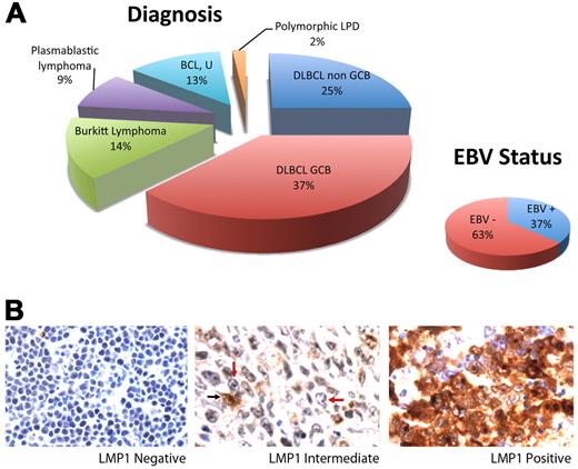 Figure 1. ARL Tumor characterization. (A) Distribution of tumor type is shown. Cases included DLBCL of the GCB (n = 21) and non-GCB (n = 14) subtypes, Burkitt lymphoma (n = 8), plasmablastic lymphoma (n = 5), B-cell lymphoma, unclassifiable (BCL, U; n = 7), and polymorphic lymphoproliferative disease (LPD; n = 1). EBV positivity shown was determined by EBER in situ hybridization. (B) LMP-1 expression as determined by immunohistochemistry. Fifty cases lacked LMP-1 in all tumor cells (left). Two cases showed LMP-1 expression in < 10% of tumor cells (middle). A tumor cell expressing LMP-1 is indicated by a black arrow, and representative tumor cells lacking LMP-1 are indicated by red arrows. Four cases expressed LMP-1 in > 90% of tumor cells (right). Original magnification ×600 with 60×/0.80 objective lens. Microscope: Olympus BX 41; camera: Olympus Q-COLOR3; software: QCapture, Version 2.9.8.0 (Quantitative Imaging Corporation).