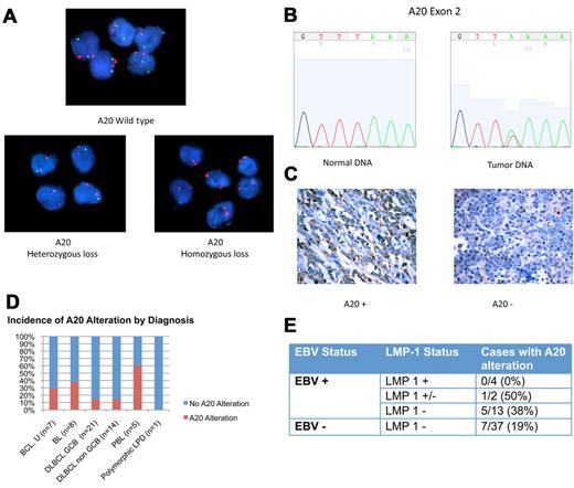 Figure 2. A20 Alterations in ARL. (A) Dual-color FISH analysis of tumor samples hybridized with A20 probe (green) and chromosome 6 centromeric probe (red). Top case shows wild-type A20. A20 heterozygous loss was shown in 5 cases (bottom left). One case was found to have A20 homozygous loss (bottom right). Magnification: Apochromatic 100× lens with 1.4 aperture; microscope: Nikon Eclipse 80i; camera: Jai CV-A10CL; software: Cytovision Imaging Software (Genetix Corp). (B) Representative chromatogram of normal DNA and tumor sample with A20 nonsense mutation in exon 2. This case had A20 monoallelic deletion, shown by FISH. The normal nucleotide peak in the mutated tumor sample probably represents infiltrating inflammatory cells. Software used was 4Peaks Version 1.7.2. (C) A20 Immunohistochemistry showing tumor cases with presence of A20 (left) and absence of A20 (right). Original magnification ×600 with 60×/0.80 objective lens. Microscope: Olympus BX 41; camera: Olympus Q-COLOR3; software: QCapture, Version 2.9.8.0 (Quantitative Imaging Corporation). (D) Incidence of A20 alteration is shown. (E) Incidence of A20 alteration in LMP-1 positive (+), negative (−), and intermediate (+/−) samples.