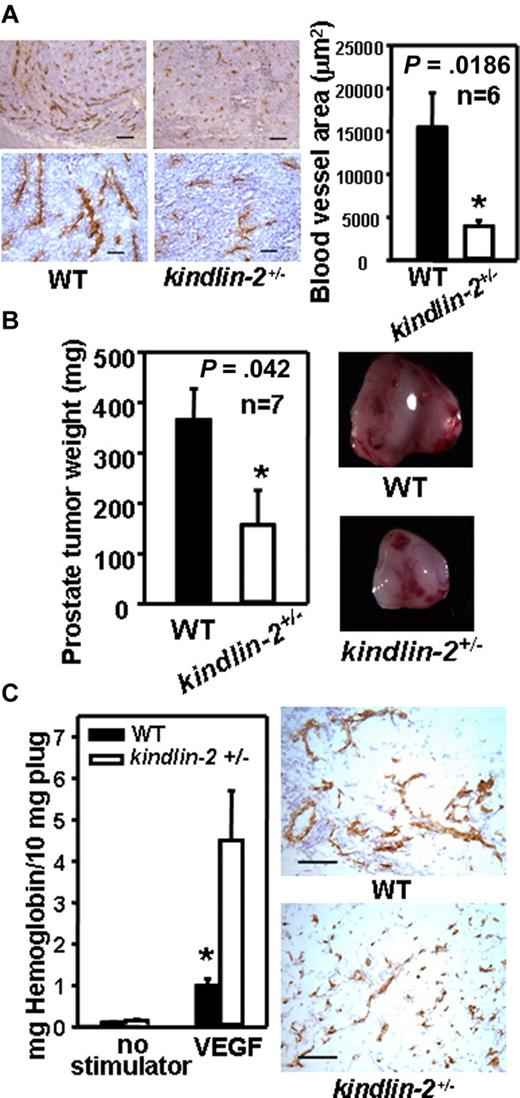 Figure 1. Abnormal angiogenesis in kindlin-2+/− mice. (A) Representative images of tumor sections stained with CD31 Ab (brown; left panel). Scale bars, 200 μm (top panel), 50 μm (bottom panel). Image analysis shows decreased area of CD31-stained vasculature in tumors grown in kindlin-2+/− mice compared with WT mice (right panel). Data are representative of 3 independent experiments with 6 mice per group. (B) Average weight of prostate tumors grown in kindlin-2+/− mice is lower than in WT mice (left panel) and representative tumors are shown (right panel). Data are means ± SEM, (n = 7 mice per group) and are representative of 3 independent experiments. (C) Angiogenesis in Matrigel implants in the presence of VEGF. (Left panel) Hemoglobin content in Matrigel implants from kindlin-2+/− mice was higher compared with WT mice. (Right panel) Representative images of Matrigel implant sections stained with CD31 Ab (brown). Scale bars, 150 μm. All data are representative of 3 independent experiments including 6 mice per group. CD31-positive areas were quantified in 5-10 independent fields per tumor implant or Matrigel plug and the average area per field was determined from duplicate measurements of each of the fields analyzed.