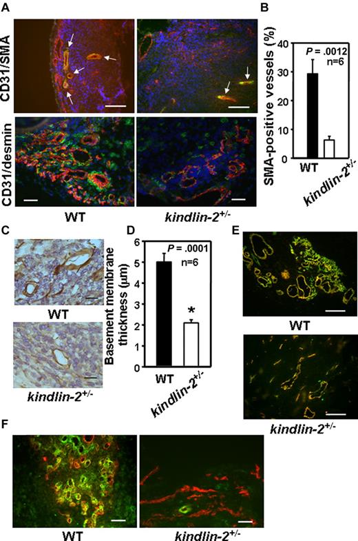 Figure 2. Neovasculature in kindlin-2+/− mice is immature. Immunohistochemistry and image analyses of RM1 prostate tumors implanted into WT and kindlin-2+/− mice. (A) Costaining for SMA (green) and CD31 (red; top panel) and for desmin (green) and CD31 (red; bottom panel) in tumors from WT and kindlin-2+/− mice. Nuclei are stained with DAPI. Arrowheads indicate SMA-positive vascular structures. Scale bars, 150 μm (top panel) and 50 μm (bottom panel). (B) Quantification of the data presented in the bottom panel of panel A. (C) Laminin-stained blood vessels in tumors grown in WT and kindlin-2+/− mice. Scale bars, 19 μm. (D) Thickness of laminin-positive basement membrane in microvessels formed in WT and kindlin-2+/− mice. Data are expressed as mean ± SEM and are representative of 3 independent experiments including 6-8 mice per group as indicated. (E) Costaining for CD105 (red) and CD31 (green). Overlay of the images reveals increased percent of CD105-positive blood vessels (yellow fluorescence) in tumors grown in kindlin-2+/− mice compared with WT mice. Scale bars, 150 μm. (F) Costaining for CD31 (red) and the pericyte marker, NG2 (green), shows reduced recruitment of pericytes and their interactions with blood vessels in tumors grown in kindlin-2+/− mice compared with WT mice. Scale bars, 50 μm. Five to 10 independent fields per tumor were examined. The images are representative of 3 independent experiments including 6-8 mice per group.