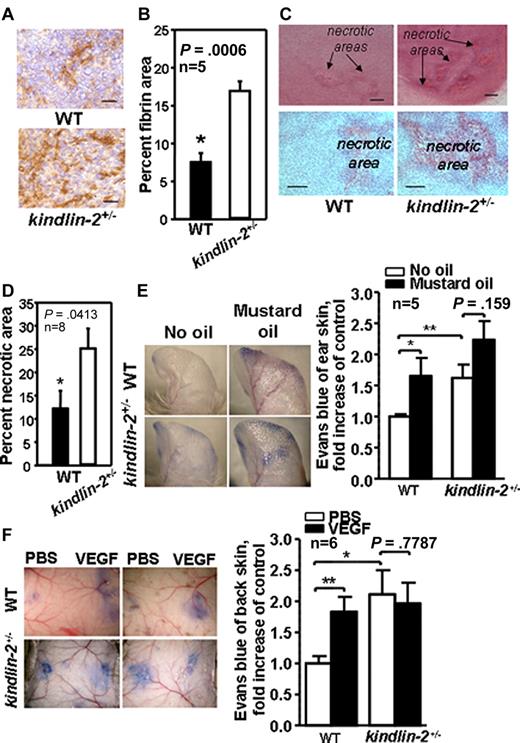 Figure 3. New and preexisting vasculature is leaky in kindlin-2+/− mice. (A) Fibrin content (brown) in tumors grown in WT and kindlin-2+/− mice. Scale bars, 30 μm. (B) Quantification of fibrin-positive area shown in panel A. (C) Representative photographs of necrotic areas in tumors grown in WT and kindlin-2+/− mice. Sections were stained with hematoxylin and eosin. Scale bars, 200 μm (top panel) and 150 μm (bottom panel). (D) Quantification of necrotic areas showed increased necrosis in tumors grown in kindlin-2+/− mice. All data are mean ± SEM and are representative of 3 independent experiments, including 5-8 mice per group as indicated. (E) Comparison of leakage from ear blood vessels in WT and kindlin-2+/− mice on stimulation with mustard oil. Blue ears of kindlin-2+/− mice indicate enhanced leakage of Evans Blue dye from blood vessels (left panel). Quantitative analysis revealed increased leakage from ear blood vessels in kindlin-2+/− mice compared with WT mice (right panel). (F) Representative photographs of Evans blue leakage from dorsal skin vasculature of WT and kindlin-2+/− mice on application of PBS or VEGF (left panel). Quantification of dorsal skin vasculature permeability (right panel). All vascular permeability data are expressed as mean ± SEM and are representative of 3 independent experiments with 5-6 mice per group as indicated.