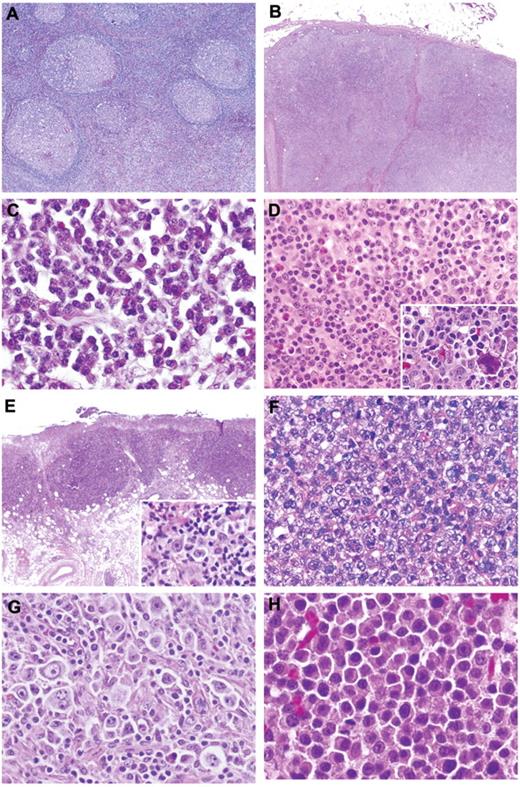 Figure 1. Histologic features of AR-EBVLPD. (A) Reactive follicular hyperplasia. (B) Reactive paracortical hyperplasia. (C) Plasma cell hyperplasia: monomorphic proliferation of uniform plasma cells. (D) Poly-N: polymorphous infiltrate comprising plasma cells, lymphocytes, and immunoblasts with occasional eosinophils. Occasional atypical HRS-like cells are noted (inset). (E) Poly-E–EBVMCU: well-circumscribed ulcerated lesion in oral mucosa with polymorphous infiltrate and HRS-like cells (inset). (F) DLBCL: “conventional” histologic picture with a diffuse proliferation of large mononuclear cells with centroblastic and immunoblastic features. Occasional pleomorphic cells are noted, but an inflammatory background is absent. (G) DLBCL: large numbers of HRS-like cells are present. (H) Plasmablastic lymphoma: the cells show basophilic cytoplasm and most have prominent nuclei (H&E; original magnifications, ×20 (B,E); ×40 (A); and ×400 (C,D,F-H and insets).