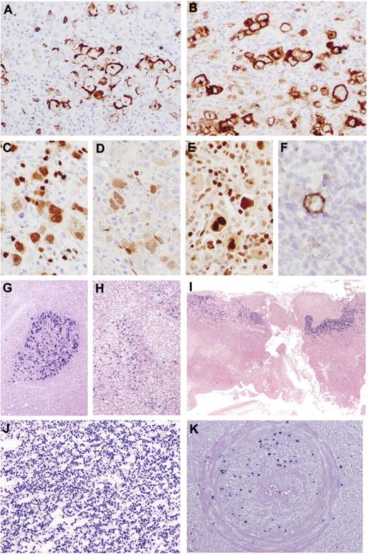 Figure 2. Immunohistochemical features and EBER in situ hybridization of AR-EBVLPD. (A-F) Poly-N with prominent HRS-like cells. (A) Reduced expression of CD20. (B) The HRS-like cells are CD30+. There is nuclear expression of PAX5 (C), Oct.2 (D), and BOB1 (E). (F) Occasional cells are positive for CD15. (G) Reactive follicular hyperplasia. Germinal center shows intense EBER positivity. (H) Reactive paracortical hyperplasia. There is paracortical/interfollicular distribution of EBER+ cells. (I) EBVMCU. Note superficial distribution of EBER+ cells. (J) Poly-N. High concentration of EBER+ cells. (K) Poly-E. Arterial wall infiltrated by EBER+ B cells. Original magnifications, ×20 (I); ×40 (G-H); ×100 (J-K); ×400 (A-E); and ×600 (F).
