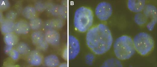 Figure 4. Examples of FISH with LSI IGH and IGL break-apart probes performed on case 18 (A) and case 42 (B), respectively. Note a split of IGH signals indicative of t(14q32/IGH) in panel A and copy number changes of IGL in panel B.