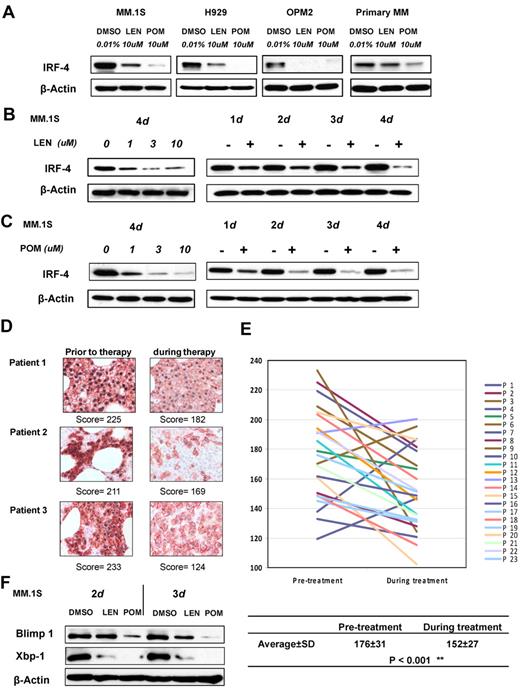Figure 2. IMiD compounds down-regulate IRF4 in MM cells in vitro and in lenalidomide-treated patients. (A) MM.1S, H929, OPM2, or primary myeloma cells were cultured with DMSO, pomalidomide, or lenalidomide at the indicated concentrations for 3 days. (B-C) MM.1S cells were incubated with lenalidomide (B) or pomalidomide (C) at different concentrations with a fixed time period of 4 days, or for different time periods with fixed concentration of 10μM, or with DMSO 0.01% as control. Cells were lysed, and cell lysates were analyzed for IRF-4 expression by Western blotting. β-actin expression was probed for loading control. (D) Double staining immunohistochemistry on paraffin-embedded marrow biopsy sections for IRF4 (black nuclear staining) and CD138+ (red staining) was performed before and during treatment with lenalidomide. Cells were rated for IRF4 reactivity as follows: 3 indicates strong; 2, moderate; and 1, negative/weak. The score for a sample is the sum of 100 cells (original magnification ×1000). (E) IRF4 scores of bone marrow biopsy samples, before and during treatment with lenalidomide. Lines connect scores from the same patients. (F) MM.1S cells were incubated with lenalidomide or pomalidomide for 2 or 3 days at 100μM. BLIMP1 and XBP1 expression was analyzed by Western blotting. β-actin expression was probed for loading control.