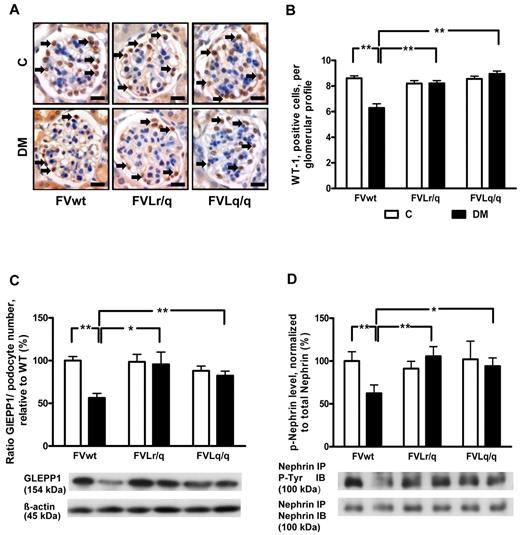 Figure 3. FVL protects against podocyte loss. (A-B) Podocyte number in glomeruli as determined by WT-1 immunohistochemical staining. Podocyte frequency was reduced in the glomeruli of diabetic wild-type mice (FVwt, arrows), but not in diabetic heterozygous (FVLr/q, arrows) or diabetic homozygous (FVLq/q, arrows) FVL mice. WT-1–positive cells detected by HRP-DAB reaction (brown) or hematoxylin counterstain (blue); n ≥ 7 for each group. (C) Bar graph (top, data normalized for podocyte numbers) and representative immunoblot (bottom) showing GLEPP1 expression in renal cortex tissue samples. GLEPP1 expression was reduced in diabetic wild-type, but not in diabetic FVL-positive mice. Actin immunoblot is shown as loading control (n ≥ 7 for each group). (D) Bar graph (top) and representative immunoblots of immunoprecipitates (bottom) showing nephrin tyrosine phosphorylation in renal cortex tissue samples. Nephrin tyrosine phosphorylation (normalized to total nephrin) is reduced in diabetic wild-type but not in diabetic FVL-positive mice. Bar graphs summarizing the results (n ≥ 7 for each group). Scale bar indicates 15 μm (A). C indicates nondiabetic, control mice (white bars); DM, diabetic mice (black bars); means ± SEM are shown; *P < .05; **P < .01 (ANOVA).