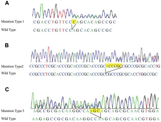 Figure 1. Sequence analyses of the N- and C-terminal CEBPA mutations in the patient and donor. (A) Leukemic cells originating from the patient at diagnosis and from the donor at DCL showed a cytosine residue duplication in the N-terminal region of the CEBPA gene (247dupC). (B) Bone marrow cells from the patient at diagnosis, remission, and DCL and his buccal mucosal specimen, as well as bone marrow cells and the buccal mucosal specimen from the donor, harbored a 6-bp germline duplication in the N-terminal region of the CEBPA gene (584_589dup). (C) Leukemic cells originating from the patient at diagnosis and from the donor at DCL showed a 3-bp duplication in the C-terminal region of the CEBPA gene (914_916dup).