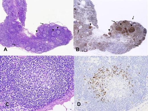 Figure 2. In situ follicular lymphoma and mantle cell lymphoma. (A) Lymph node with a reactive appearance. (B) BCL2 staining shows strong positive cells in some germinal centers (arrows) but not in others (arrowheads). (C) Lymphoid follicle with reactive appearance. (D) Cyclin D1 staining highlights a corona of positive cells in the mantle area. Photographic images were acquired with a Nikon Eclipse 50i microscope equipped with an Olympus (Olympus America Inc) DP71 camera and software. Final image preparation was performed with Adobe Photoshop CS4 extended Version 11.0.2. Original magnifications as follows: panel A(20×/0.1 NA); panel B (20×/0.1 NA); panel C (200×/0.75 NA); panel D (200×/0.75 NA).