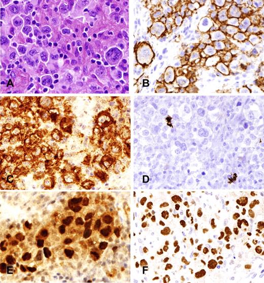 Figure 3. B-cell lymphoma unclassifiable, intermediate between diffuse large B-cell lymphoma and Hodgkin lymphoma. (A) Neoplastic cells resemble Hodgkin/Reed-Sternberg cells (H&E) but show retention of a full B-cell program. (B) CD20 is uniformly positive. (C) CD30 is positive, but CD15 (D) is negative. Both PAX5 (E) and OCT-2 (F) are strongly expressed. Photomicrographic images were acquired with a Nikon Eclipse 50i microscope equipped with an Olympus (Olympus America Inc) DP71 camera and software. Final image preparation was performed with Adobe Photoshop CS4 extended Version 11.0.2. Original magnifications as follows: panels A-F (400×/0.95 NA).