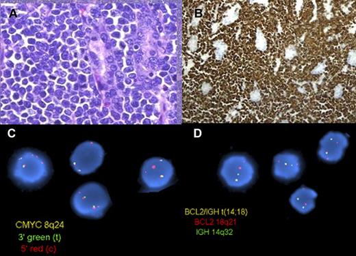 Figure 4. B-cell lymphoma unclassifiable, intermediate between diffuse large B-cell lymphoma and Burkitt lymphoma, with translocations involving MYC and BCL2 (double hit). (A) A high-grade lymphoma involves the gastric mucosa of a patient with a history of low-grade follicular lymphoma (H&E). (B) At higher magnification, the cells are medium-sized and monomorphic with a high mitotic rate (H&E). (C) The cells are strongly positive for Bcl2 (Bcl2 immunoperoxidase stain). (D) FISH on interphase nuclei using a dual-color dual fusion probe for the BCL2 and IGH loci (top) shows one abnormal (yellow) signal in most cells, indicating a translocation involving the BCL2 and IGH genes. FISH on interphase nuclei with the use of a dual-color break-apart probe for the MYC locus (bottom) shows 1-2 yellow signals (normal) and 2-3 red signals, indicating a break at the MYC locus, with loss of the 3′ end of MYC, consistent with an unbalanced or complex MYC rearrangement. Panels A, B, and C were provided by Dr Aliyah Sohani, Department of Pathology, Massachusetts General Hospital. Panel D is reprinted from Snuderl et al.106