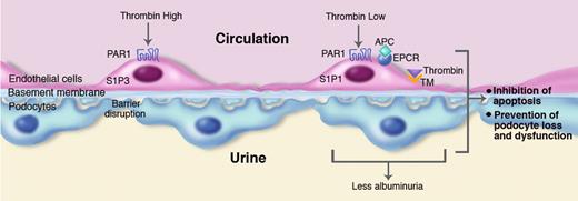 Role of thrombin in diabetic nephropathy. Sustained hyperglycemia results in diabetic nephropathy characterized by apoptosis of glomerular cells and loss and dysfunction of podocytes and albuminuria. Left side: High thrombin concentrations can induce disruption of the physiologic vascular barrier by an effect on protease activated receptor (PAR)1-dependent signaling via sphingosine 1 phosphate S1P receptor 3 (S1P3). High thrombin levels can also cause enhanced apoptosis of podocytes (not depicted in the figure). Right side: Low thrombin concentrations and the presence of activated protein C (APC) cause barrier protective effects via PAR1-dependent activation of another S1P receptor, S1P1. Both low thrombin levels and APC inhibit apoptosis of endothelial cells, as well as apoptosis and loss and dysfunction of podocytes, resulting in reduced albuminuria. Thrombin bound to thrombomodulin (TM) is essential for APC generation, a process augmented by the presence of the endothelial cell protein C receptor (EPCR). In this of Blood, Wang and colleagues4 show that the Factor V Leiden mutation, which is associated with modestly elevated thrombin generation, protects against diabetic nephropathy by mechanisms indicated in the right panel of the figure. Professional illustration by Marie Dauenheimer.
