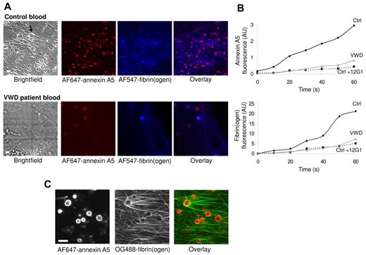 Figure 8. Contribution of GpIb-V-IX and VWF to fibrin formation in whole blood. Platelets were superfused with recalcified whole blood at a shear rate of 250 s−1 for 5 minutes, after which the flow was stepwise reduced every 2.5 minutes to reach 125 s−1 at 10 minutes. Blood from healthy control subjects (Ctrl) or type 1 VWD patients was supplemented with labeled fibrinogen (150 μg/mL), AF647–annexin A5 (0.5 μg/mL) and/or 12G1 mAb (10 μg/mL). Bright-field and confocal fluorescence images were captured at 10 minutes (t = 0) with a Biorad/Zeiss laser-scanning microscope system (see “Methods”). (A) Representative images taken after 60 seconds, showing clusters of PS-exposing platelets and a growing fibrin network. Arrow indicates thrombus (bars, 10 μm). (B), Time plots showing fluorescence accumulation of AF546-fibrin(ogen) (blue) and AF647–annexin A5 (red). (C), High-resolution confocal images of OG488-fibrin(ogen) and AF647–annexin A5 fluorescence. Data are representative of 3 or more experiments.