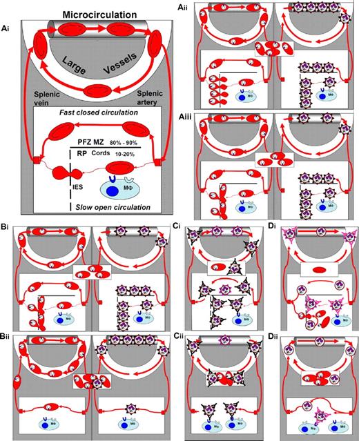 Figure 3. Interactions of P falciparum–infected RBCs with the microcirculation, and with the spleen during acute and chronic infection in patients with normal or impaired splenic function. (Ai) Simplified frame from Figure 1. For simplicity, all nonsplenic microcirculatory structures—either systemic or pulmonary—have been considered homogenous and are presented as a single microvascular channel at the top of the panel (PFZ MZ: perifollicular or marginal zones; RP: red pulp; interendothelial slits: interendothelial slits). Of note, large vessels correspond to the only compartment that can routinely be explored for the presence of infected RBCs (thin and thick smears, or PCR). Forms observed in the rectangle in the middle of the panel symbolize what is usually observed on patient smears in the corresponding situation. (Aii) Situation in a naïve patient (see text for definition) with a normal spleen function. Interactions are shown separately for the young ring forms (rings, left panel) and the mature forms (right panel). (Aiii) Same situation as above, but integrating the retention of a proportion of rings upstream from interendothelial slits, as recently observed in an ex vivo human spleen model.6 (Bi-ii) Comparative modeling of situations during the first acute infection in unsplenectomized (Bi top panel identical to panel Aiii) and splenectomized patients (Bii lower panel). (Ci-ii) Comparison of acute infection in immune unsplenectomized (panel Bi identical to panel Aiii) or splenectomized patients still exposed to P falciparum transmission after splenectomy (Bii). (Di-ii) Putative mechanisms of acute malaria attacks occurring a few weeks after splenectomy in chronic carriers no longer exposed to P falciparum transmission.
