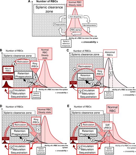 Figure 4. Ability of RBCs to cross the spleen, dispersion of individual values, and possible variability of the splenic detection threshold in the context of P falciparum infection. (A) The speculative distribution of mature RBCs with different levels of splenic “crossability” at homeostasis. Approximately 1% of the circulating RBC population loses its ability to cross the spleen each day. When the spleen crossability of a RBC is below the splenic retention threshold, the corresponding RBC is retained in the cords of the red pulp. This retention is expected to trigger phagocytosis, followed by iron recycling into erythropoiesis. Aging of a RBC is associated with a progressive reduction of RBC deformability that influences RBC crossability.99 A link between deformability (assessed by ektacytometry) and spleen crossability has been established in thalassaemia.100 (B) 1. The elongation of ring-infected RBCs is reduced18 with a wide dispersion of individual values, as assessed using optical tweezers.32 Deformability values of rings span the splenic retention threshold, as shown by the retention of rings in an ex vivo human spleen-perfusion system.6 2. The splenic crossability of a proportion of the ring population is therefore below the splenic retention threshold. This subpopulation is retained and (at least partially) phagocytosed, therefore unable to sequester in the vasculature of other organs. 3. The subpopulation that is still able to circulate is available for maturation and subsequent cytoadherence-based sequestration. Despite their gross inability to cross the spleen, cytoadherent mature forms are protected from splenic retention by sequestration in the microcirculation. 4. The biomass of sequestered mature forms generated at each cycle thus depends on the proportion of circulating rings and determines the number of rings produced at the next reinvasion wave.5 The proportion of rings allowed to circulate through the spleen is therefore a determinant of the in vivo multiplication factor of the parasite biomass. (C) Influence of a left shift in the crossability of RBCs. Several RBC disorders/polymorphisms are associated with a reduced RBC deformability or decreased ability of RBCs to cross the spleen (1). This abnormality may induce a similar shift in the deformability of ring-infected RBCs. The subpopulation of rings retained is therefore greater, and the subpopulation allowed to circulate until maturation and sequestration is smaller, giving rise to a smaller sequestered biomass of mature forms. The number of rings generated at the next reinvasion cycle is also smaller, leading to a reduced in vivo multiplication factor. This process may account for part of the protection from severe malaria induced by the HbAS trait (see text). (D) In an anemic condition, when a greater number of normal RBCs are retained in the spleen, the spleen clearance zone will be shifted to the right. If the splenicretention threshold is higher (1) (ie, the spleen retains RBCs with a higher crossability), the subpopulation of rings retained is greater (2), and the subpopulation allowed to circulate until maturation and sequestration is smaller (3), giving rise to a smaller sequestered biomass of mature forms. The number of rings generated at the next reinvasion cycle is also smaller, leading to a reduced in vivo multiplication factor. A more stringent spleen retention threshold also induces the retention of a greater proportion of normal RBCs, thereby favoring the occurrence of anemia. (E) Uninfected RBCs in the blood of patients or in culture usually have a reduced deformability (1). The population distribution curve of uninfected RBCs is therefore shifted to the left, a phenomenon predicted to increase the proportion of uninfected RBCs retained in the spleen, and thereby RBC loss and subacute/acute anemia. The existence of this third subpopulation of RBCs explains how anemia and a decrease of the deformability of circulating RBCs can be associated.6,34 Whether this process affecting uninfected RBCs is unimodal or multimodal is not known.