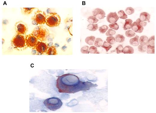 Figure 1. Immunohistochemical staining of DC, tumor, and fusion cells. (A) Autologous DCs were generated from adherent mononuclear cells isolated from a leukapheresis collection. DCs were cultured with GM-CSF and interleukin-4 for 5 days and then with tumor necrosis factorα for 48-72 hours. DC preparations were analyzed for expression of costimulatory molecules. DC expression of CD86 (red) is shown (×60). (B) Patient-derived myeloma cells were cultured in RPMI 1640 complete medium and were analyzed for expression of the tumor-associated antigens CD138 and CD38. Tumor expression of CD38 (red) is shown (60×). (C) Fusion cells were generated by coculture of DCs and myeloma cells in the presence of polyethylene glycol. Fusion cell preparations were analyzed for coexpression of the DC-derived costimulatory molecule CD86 (blue) and tumor-associated antigen CD38 (red).