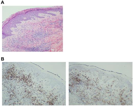 Figure 3. Biopsy of a vaccine-site reaction. A biopsy of vaccine-site reactions was obtained, fixed in formalin, and stained with hematoxylin and eosin. To further characterize the nature of the cellular infiltrate, immunohistochemical staining for CD8+ and CD1a was performed. (A) A representative example of a vaccine site reaction biopsy is shown, demonstrating a dense mononuclear cell infiltrate at the vaccine site. (B) A representative example of immunohistochemical staining is shown, demonstrating an infiltrate of CD8+ T cells (left) and CD1a+ immature DCs (right) at the biopsy site.