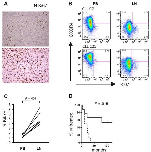 Figure 7. Tumor proliferation in the LN correlates with disease progression. (A) Magnification (×200) of LN biopsies of 2 representative CLL samples: top panel, preferential Ki67 staining in proliferation centers; bottom panel, diffuse Ki67 positivity. (B) Ki67 expression was assessed by flow cytometry in CD3− cells from the indicated anatomical sites. Shown are 2 representative patients of a total of 6 analyzed. Cutoffs in each sample were chosen so that PB cells were around 1% Ki67+ cells. (C) Ki67 expression in CD3− cells from the indicated anatomic sites. Statistical comparison was by paired Student t test. (D) Kaplan-Meier analysis of time to treatment in all patients with LN biopsies (n = 17) based on E2F scores: dashed line, scores above the median; solid line, scores below the median.