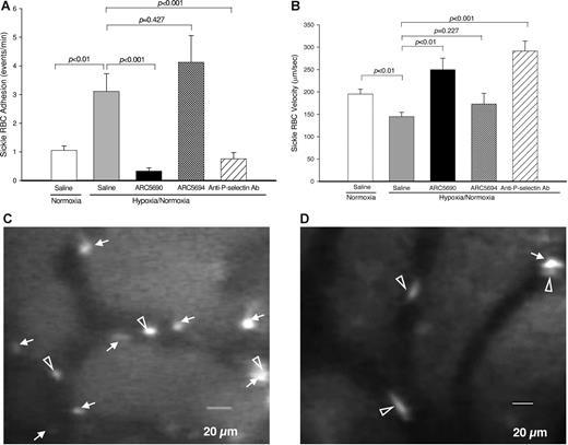 Figure 4. Anti–P-selectin aptamer ARC5690 reduces sickle RBC adhesion and increases microvascular flow velocities. (A) ARC5690 inhibits sickle RBC adhesion. Adhesion of labeled RBCs was defined as the number of events (adhesion time more than 1.0 seconds/min in a 100-μm length of vessels by frame–by–frame analysis of video replay. Treatment with ARC5690 before hypoxia/normoxia stress reduced the number of adherent RBCs by 90% compared with saline-treated mice (P < .001). No difference in sickle-RBC adhesion was observed in the ARC5694-treated group compared with saline group (P = .427). (B) ARC5690 improves sickle RBC velocities. Sickle RBC velocities were determined off-line by frame–by–frame analysis of video-recorded microscopic images using Image Pro-Plus 5.0 software. Five to 8 RBC velocity measurements were performed along the centerline of the vessel and used to define the mean centerline VRBC. Mean VRBC (Vmean) was calculated using a conversion factor of 1.6 (VRBC/Vmean = 1.6). Compared with saline-treated mice, RBC velocities were increased in ARC5690 treated group (P < .01), but not in ARC5694-treated mice (P = .227). (C-D) Frame-captured images from videotaped intravital microscopy of bone marrow venules in SCD mice injected with saline (C) and ARC5690 (D). Saline-treated mice show more adherent sickle RBCs (white arrows). Pretreatment with ARC5690 reduced the number of adherent sickle RBCs. Open arrowheads identify RBCs moving slowly in saline-treated mice (C) and rapidly in the aptamer-treated mice (D). Values were mean ± SE obtained from 4 to 5 mice in each group. The number of venules in experimental groups ranged from 18 to 21. P values for statistical analyses are shown on top of the figures.