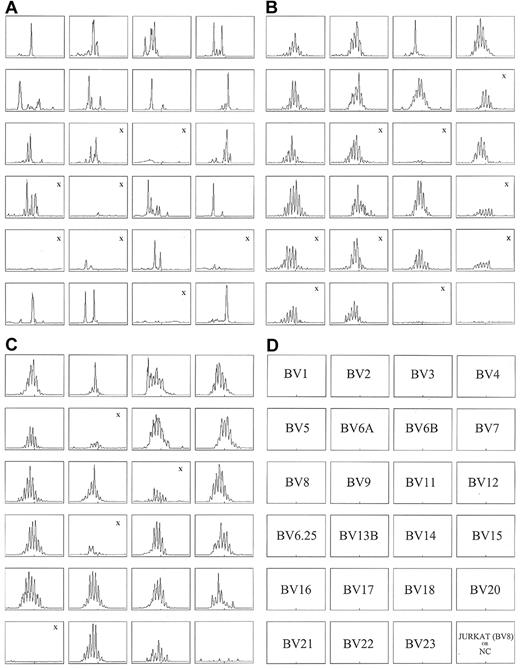 Figure 2. CD4 RNA spectratyping shows oligoclonality in subject 1 before transplantation and polyclonality in both subjects after transplantation. Subject 1 at (A) day −127 and (B) day 873 after transplantation; subject 2 at (C) day 368 after transplantation. The DKL score for subject 1 pretransplantation (A) is 1.38 compared with the DKL score of 0.19 after transplantation (B). For subject 2, the posttransplantation DKL was 0.08 (C). Lower DKL scores reflect greater diversity in the TCR repertoire. The “X” indicates panels with insufficient RNA concentrations. These panels were not included in the calculation of the DKL score. NC indicates negative control.