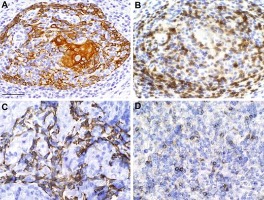Figure 3. Biopsy evaluation of thymus allografts shows thymopoiesis. Subject 1 (A-B) and subject 2 (C-D). Cytokeratin reactivity (A,C) and CD3 reactivity (B,D). Scale bar, 50 μm. The microscope was an Olympus VANOX AHBS3. The magnification was 40× using a 40× numerical aperture objective lens (Olympus SPLAN 40×). The photomicrograph was taken at room temperature. Neither imaging media nor fluorochromes were used. The camera used was an Olympus DP70 digital imaging camera. Acquisition software was Olympus DP Controller. Subsequently, Adobe Photoshop 6.0 was used to compose this figure.
