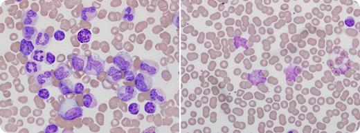 A 53-year-old man with a 9-year history of untreated chronic lymphocytic leukemia (CLL) was evaluated for marked leukocytosis. He had increased fatigue, low-volume axillary lymphadenopathy, and a palpable spleen. The leukocyte count was 294 × 109/L, hemoglobin 112 g/L, and platelet count 261 × 109/L. / His blood film (left) showed a spectrum of granulocytes with predominance of mature forms, and scattered small, mature lymphocytes. Bone marrow aspirate and biopsy showed marked granulocytic hyperplasia and small lymphoid aggregates with marked hypercellularity. Cytogenetic translocation (9;22)(q34;q11.2) and BCR-ABL1 positivity confirmed chronic myeloid leukemia (CML). The patient was treated with imatinib with a resolution of splenomegaly and a reversion of the bone marrow and blood film (right) to again show morphologic evidence of CLL. Posttreatment leukocyte count was 13 × 109/L with absolute lymphocytosis and scattered smudge cells, platelet count 161 × 109/L, and flow cytometry that affirmed CLL. / Patients with CLL have an increased frequency of various malignancies. However, the occurrence of CML with CLL is rare. In most reported instances, CML appears after an earlier diagnosis of CLL. These 2 leukemias appear to occur associated with separate genomic events.