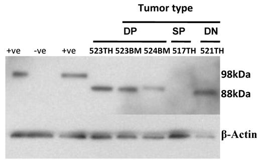 Figure 5. Activation of Notch1 during Lmo2 tumorigenesis. Levels of NICD present in extracts of tumors from double-positive (DP), double-negative (DN), and single-positive (SP) T cells tumors from animals described in Figure 1B were assessed by immunoblotting using a rabbit monoclonal antibody to Notch1 cleaved at val1744 (D3B8; Cell Signaling Technology) at a dilution of 1:250. Jurkat cells were used as the positive control (+ve) and GPE-86 cells were used as the negative control (-ve). The Mouse NICD is smaller than the human form with a predicated molecular weight of 85kDa. β-actin was used as the loading control. The mouse number and tissue source (TH indicates thymus; BM, bone marrow) are shown for each lane.