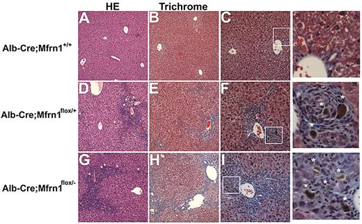 Figure 7. Histochemical analysis of wild-type and hepatocyte-deleted Mfrn1 livers. Livers from mice fed ALA were harvested at 6 weeks and stained with hematoxylin and eosin (A) or trichrome (B) in Alb-Cre;Mfrn1+/+. (C) Enlarged image from panel B. Alb-Cre;Mfrn1flox/+ were stained with hematoxylin and eosin (D) or trichrome (E). Panel F is an enlarged image from panel E. Alb-Cre;Mfrnlflox/− were stained with hematoxylin and eosin (G) or trichrome (H). Panel I is an enlarged image from panel G. Asterisks in the enlarged images of panels F and I denote areas of fibrosis.