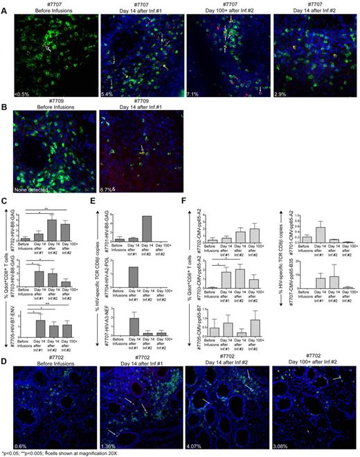 Figure 6. Infused HIV-specific CD8+ T-cell clones survey the rectal mucosa. (A-B) Fluorescence images of fresh rectal tissue sections (30 μm) from patient 7707 (A) and 7709 (B) stained with DAPI in blue, CD8 in green and Qdot655 multimer A*0301/QVPLRPMTYK-HIV-NEF for patient 7707 and Qdot655 multimer B*2705/KRWIILGLNK-HIV-GAG for patient 7709 in red. Arrows indicate Qdot655+CD8+cells (yellow). Inset percentage values reflect Qdot655+CD8+ T cells as a percent of total CD8+ T cells. (C) Cryopreserved rectal tissue sections stained concurrently with CD8 and the corresponding HIV-specific Qdot655 multimer B*0801/GEIYKRWII-HIV-GAG for 7702 and 7703; B*0702/IPRRIRQGL-HIV-ENV for 7705. Ten fields of 1 mm2 spanning 2 rectal biopsies per time point were enumerated for CD8+Qdot655+ T cells and results expressed as a percentage of total CD8+ T cells. (D) Fluorescence images of cryopreserved rectal tissue sections (7 μm) from patient 7702 stained with DAPI in blue, CD8 in green, and Qdot 655 multimer. B*0801/GEIYKRWII-HIV-GAG in red. Inset values represent the average of 10 counted fields. (E) Frequencies of HIV-specific T cells in rectal biopsies for patients 7701, 7704, and 7707 expressed as a percent HIV-specific Vβ copies relative to CD8β copies. Results are an average of 2 independent rectal samples taken at each time point. (F) CMV-specific CD8+ T cell clones quantified in rectal biopsies from patients 7701 and 7707 (TCR-specific RT-PCR) and CMV-specific CD8+ T-cell clones in rectal biopsies from patients 7702, 7703, and 7707 (specific Qdot655 multimers). One-tailed, paired Student t tests were used for statistical analysis.