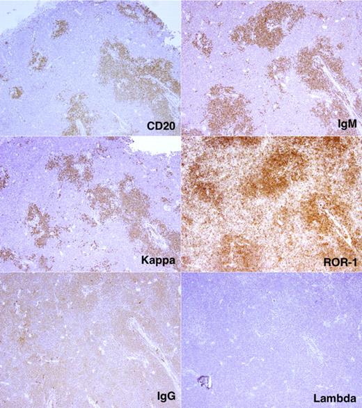 Figure 6. Localization and characterization of CLL cells in NSG spleen. CD20+ cells with monotypic IGH (μ) and immunoglobulin light (κ) chains form follicular structures in the spleen. These cells are also ROR1+. Note the intimate relationship between the follicular structures and blood vessels.