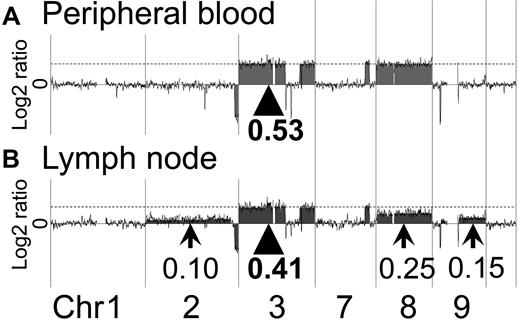 Figure 1. Representative profiles of the PB and LN samples of case 1. Array CGH results for case 1 are shown. (A) In the PB sample of case 1, regions of gain were detected. The log2 ratio of chromosome 3 was 0.53 (arrowhead). The log2 ratios of chromosomes 7 and 8 were the same as for chromosome 3 (dotted line). (B) In the LN sample of case 1, a log2 ratio imbalance was found. Log2 ratios among chromosomes 2, 3, 7, 8, and 9 differed. The log2 ratios of chromosome 3 and 7 were 0.41 (arrowhead and dotted line). Arrows show different log2 ratios: chromosome 2 = 0.10, chromosome 8 = 0.25, and chromosome 9 = 0.15.