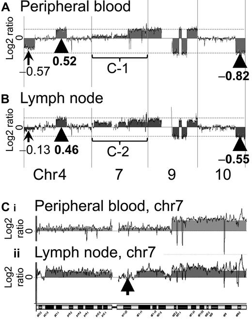 Figure 2. Representative profiles of the PB and LN samples of case 2. The results for case 2 were more complex than those for case 1. In both the PB and the LN samples of case 2, a log2 ratio imbalance was found. (A) In the PB sample, the arrowhead and dotted line indicate the majority of log2 ratios of gain and loss regions. Log2 ratios of the majority of loss regions were −0.82. The log2 ratio of chromosome 4 was −0.57. (B) In the LN sample, the arrowhead and dotted line indicate the majority of log2 ratios of gain and loss regions. Log2 ratios of the majority of loss regions were −0.55. The log2 ratio of chromosome 4 was −0.13. Chromosome 7 regions of PB and LN samples are magnified as Ci and Cii, respectively. (C) Chromosome 7 of the case 2 PB sample shows complex aberrations (i). This result also indicates a log2 ratio imbalance. Chromosome 7 of the case 2 LN sample shows more complex aberrations (ii). An arrow indicates a region (7q11.21-11q.23) without genomic aberration. Ci and Cii suggest that the genomic profiles of the PB and LN samples differ.