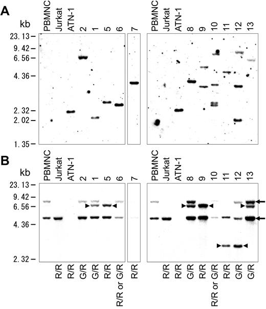 Figure 5. Southern blot analysis. (A) Southern blot analysis of HTLV-1 integration in 11 of 13 cases. (B) Southern blot analysis of TCRγ rearrangement. Arrows indicate the 8.00- and 4.9-kb germline bands. Arrowheads indicate the 6.8- and 2.9-kb rearrangement bands. G indicates a germinal allele; R, rearrangement allele; G/R, rearrangement of one allele; R/R, rearrangement of both alleles.
