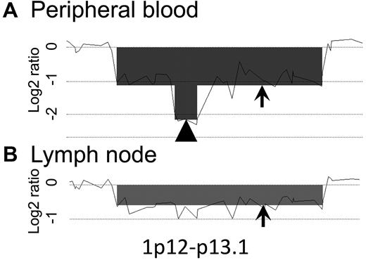 Figure 6. Homozygous loss region analysis. A representative homozygous loss region of case 2 is shown (1p12-p13.1). The total scale of the figure is approximately 2 Mb. The arrowhead indicates a homozygous loss region; arrows indicate heterozygous loss regions. Homozygous loss was found only in the PB sample. The log2 ratio of this region in the LN sample was slightly lower than that in the neighboring regions, suggesting the possibility that a minor subclone may exist in the LNs.