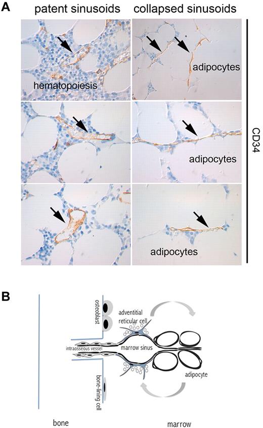 Figure 2. “Pruning” of sinusoids in adipose marrow. (A) CD34-immunolabeled sinusoids as seen in red and yellow areas of human iliac crest bone marrow. The lumen of sinusoids (arrows) running among hematopoietic areas is patent; the lumen of sinusoids running among adipocytes is virtual. (B) The connection of marrow vascularity to bone and fat. Marrow vascularity communicates with bone vascularity. Marrow adipogenesis involves adventitial stromal cells and is coupled with changes in sinusoid caliber.
