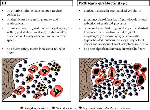 Figure 1. Diagnostic criteria of distinctive value regarding WHO-defined ET (left) versus early-prefibrotic stage of PMF (right), including standardized morphologic features (Table 1 contains more details), allowing the generation of characteristic histologic BM patterns.