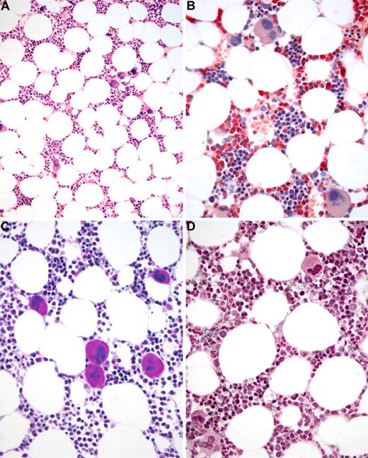 Figure 2. BM biopsy histology in ET in overview (×70) and low-power (×210) field. (A) Survey with hematoxylin and eosin-stained section shows an age-matched cellularity but prominent large to giant mature megakaryocytes in random distribution or loose clusters. (B) Chloroacetate esterase reaction demonstrates a normal amount and distribution of neutrophil granulopoiesis (red) and erythropoiesis besides the prominent megakaryocytes. (C) PAS staining reveals a hyperlobulation of megakaryocyte nuclei (almost staghorn-like) and mature cytoplasm without evidence of significant abnormalities. (D) Reticulin stain discloses no increase in fibers but large megakaryocytes. Images were acquired using Zeiss Axioplan 2, 10×/0.50 and 20×/0.50 EC PlanNeofluar.