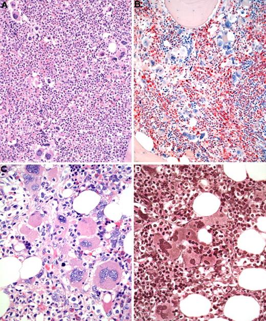 Figure 3. BM biopsy histology in early PMF in low-power (×170) or medium-power (×350) field. (A) Survey with hematoxylin and eosin-stained section shows increase in age-matched cellularity and conspicuous clusters of atypical megakaryocytes. (B) Chloroacetate esterase reaction discloses that increased cellularity is mostly the result of neutrophil granulopoiesis (red) and prominent clustering of large, abnormal megakaryocytes with paratrabecular dislocation. (C) PAS staining reveals not only loose and tight clustering but also striking abnormalities of megakaryocytes showing large hyperchromatic-hypolobulated, cloud-like nuclei. (D) Reticulin stain displays minimal increase with a fine network of fibers between the clustered abnormal megakaryocytes. Images were acquired using Zeiss Axioplan 2, 20×/0.50 and 40×/0.60 EC PlanNeofluar.
