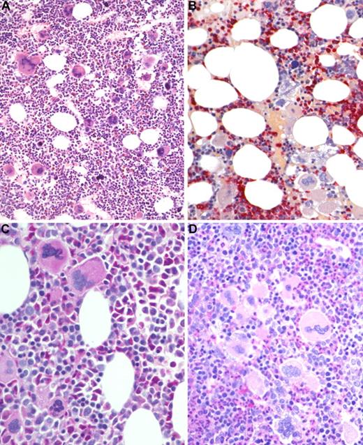 Figure 4. BM biopsy histology in ET/PV in low-power (×170) or medium-power (×350) field. (A) Survey with hematoxylin and eosin-stained section shows hypercellularity with conspicuous small to giant megakaryocytes and increased erythropoiesis and granulopoiesis. (B) Chloroacetate esterase reaction indicates panmyelosis or a PV-like picture: proliferation of neutrophil granulopoiesis (red) and large inlets of nucleated erythroid precursors intermingled with small to large megakaryocytes. (C) PAS staining demonstrates large to giant megakaryocytes, some with hyperlobulated (staghorn-like) nuclei surrounded by mature cytoplasms (resembling ET; see Figure 1C). (D) PAS staining with grouping of small to giant megakaryocytes with moderate nuclear lobulation consistent with a PV-like appearance. Images were acquired using Zeiss Axioplan 2, 20×/0.50 and 40×/0.60 EC PlanNeofluar.