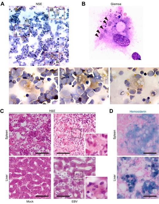 Figure 2. Hemophagocytosis in EBV-infected NOG-hCD34 mice. (A-B) Hemophagocytosis in the BM of EBV-infected mice. The specimens of the BM fluid smear of EBV-infected mice were prepared and assessed by NSE staining (A) and Giemsa staining (B). (A) NSE staining. Histiocytes (brown) and neutrophils (blue) were stained. Areas enclosed with squares (i-iii) indicate the histiocytes with granules and are, respectively, enlarged in panels i through iii. (B) Giemsa staining. A representative histiocyte with phagocytosis is shown. Arrowheads indicate engulfed erythrocytes. (C-D) Hemophagocytosis in the spleen and hepatic sinusoid of EBV-infected mice. Tissue sections were assessed by H&E staining (C) and Berlin blue staining (hemosiderin staining; D). (C) H&E staining. Representatives of spleen (top) and liver (bottom) of mock-infected mice (left) and EBV-infected mice (right) are shown. Areas enclosed with squares are enlarged in the bottom right of each panel and indicate morphologically activated histiocytes. (D) Berlin blue staining. Representatives of spleen (top) and liver (bottom) of EBV-infected mice are shown. Note that the cells stained with blue indicate hemosiderin-containing hemophagocytic histiocytes. Scale bars in panels C and D represent 50 μm.