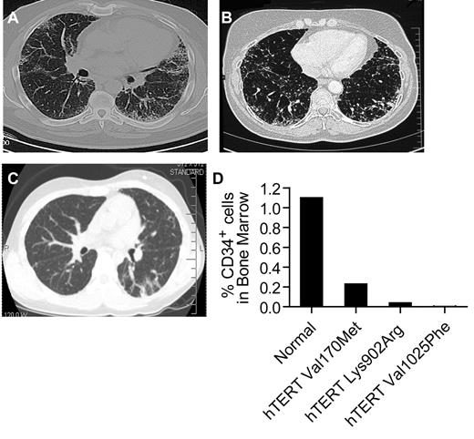 Figure 1. Evidence of both pulmonary fibrosis and bone marrow failure in individuals with mutant telomerase genes. (A-B) Representative CAT scan images showing typical peripheral honeycombing pattern in 2 individuals with idiopathic pulmonary fibrosis and pancytopenia. Both individuals had biopsy confirmation of the usual interstitial pneumonia. The scans are from individuals in families 2 and 6. (C) CAT scan image of the proband of family 7, who developed pulmonary fibrosis after bone marrow transplantation for AA. Biopsy confirmed nonspecific interstitial pneumonia. (D) For the 3 individuals with images shown, the percentage of bone marrow CD34+ cells by flow cytometry was decreased in the setting of pancytopenia, macrocytosis, and hypocellular/aplastic marrow. The 95% confidence interval for CD34+ percentage is 0.4%-1.8%.
