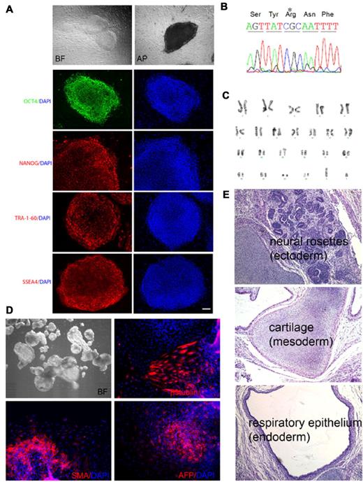 Figure 1. Characterization of X-CGD iPSC line iXC1. Line iXC1 (A) exhibits characteristic human ESC-like morphology in bright field (BF) microscopy (top left) and expresses pluripotency markers that include alkaline phosphatase (AP) activity (top right) and fluorescence antibody staining for OCT4, NANOG, TRA-1-60, and SSEA-4 (left panels in green and red). Blue staining (right panels) are 4′-6-Diamidino-2-phenylindole (DAPI) staining of nuclei (bar = 100 μm); (B) has the CYBB 458T→G mutation; (C) has normal male karyotype; (D) forms embryoid bodies in vitro shown by BF (top left) microscopic appearance, and by expression of β-tubulin class III neuroectoderm marker (top right), smooth muscle actin (SMA) mesoderm marker (bottom left), and α-fetoprotein (AFP) endoderm marker (bottom right); (E) forms teratomas in vivo in NSG mice that include all 3 germ layers, identified here as neural rosette ectoderm (top), cartilage mesoderm (middle), and respiratory epithelial endoderm (bottom). Not shown is that RT-PCR analysis of cDNA generated from the iXC1 teratoma confirmed presence of mRNA specific for human PAX6 (ectoderm), CD34 (mesoderm), and α-feto-protein (endoderm).