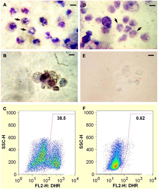 Figure 2. Neutrophil differentiation of X-CGD iPSC line iXC9 and normal control human iPSC line iPS(IMR90). Panels A-C show cytospin Giemsa stain, cytospin NBT assay, and DHR flow cytometric analysis, respectively, of neutrophils arising from differentiation of normal control iPSC line iPS(IMR90). Panels D-F are cytospin Giemsa stain, cytospin NBT assay, and DHR flow cytometric analysis, respectively, of neutrophils arising from differentiation of X-CGD iPSC line iXC9. Arrows in the cytospin Giemsa stain images (A,D) indicate some of the cells with mature neutrophil morphology (bar = 10 μm). Cytospin NBT assay shows blue-black formazan precipitates resulting from robust ROS production by PMA-activated neutrophils derived from normal control iPSCs (B), but lack of formazan precipitates indicating no ROS production by neutrophils derived from X-CGD iPSCs (E). The DHR dot plot images (y-axis side scatter; x-axis DHR fluorescence) demonstrate robust ROS production (high fluorescence) by 38.5% of PMA-activated cells representing mature neutrophils derived from normal control iPSCs (C), but no evidence of any significant ROS production by PMA-activated neutrophils derived from X-CGD iPSCs (F).