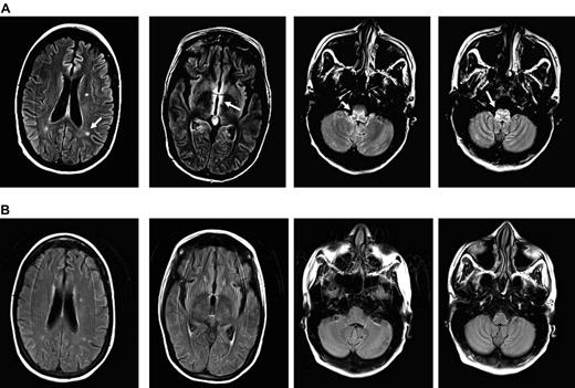 Figure 1. MRI images of CMV encephalitis before and after U-DLI. (A) Axial T2 fluid-attenuated inversion recovery (FLAIR) images demonstrate 3 new white matter lesions, increased signal, and edema in the periventricular region most notable around the third ventricle and medulla (white arrows). (B) Axial FLAIR images demonstrate resolution of previously described lesions and increased signal/edema 6 months after the initial U-DLI.
