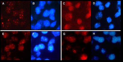 Figure 1. MCPyV detection by FISH in previously reported MCC and CLL cases.1,4 MCPyV FISH was carried out using tyramide signal amplification (TSA) as described previously.3,5 Signal evaluation was performed with a Leica DM 5000 B fluorescence microscope (Leica) using 1000× magnification and specific filter sets for Texas red to visualize MCPyV (A,C,E,G) and DAPI showing blue nuclear counterstaining (B,D,F,H). (A-B) MCPyV detection in MCC and corresponding DAPI (B). (C-D) Negative control on MCC tissue without probe and corresponding DAPI (D). (E-F) MCPyV detection in CLL cells of a bone marrow trephine and corresponding DAPI (F). (G-H) MCPyV detection in another CLL case in a bone marrow trephine and corresponding DAPI (H).