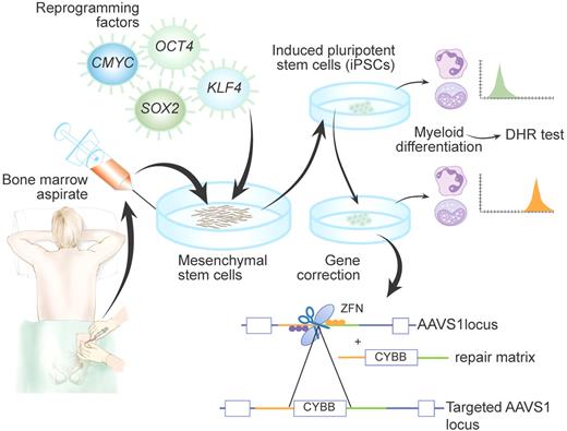 Schematic representation of generation and targeting of induced pluripotent stem cells (iPSCs) derived from a patient with X-linked chronic granulomatous disease (X-CGD), as achieved by Zou et al2 Di-hydrorhodamine (DHR) test was used to confirm that patient-derived iPSCs differentiated into myeloid cells recapitulate the CGD phenotype. Insertion of the CYBB gene into the AAVS1 locus by zinc-finger nucleases (ZFNs) allowed rescue of the cellular phenotype. Professional illustration by Paulette Dennis.
