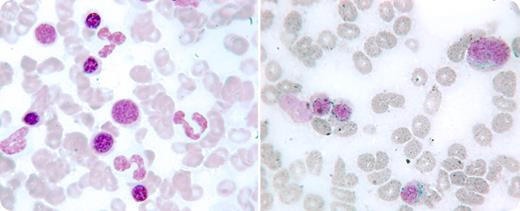 An 84-year-old woman with a long-standing history of progressive exertional dyspnea and fatigue was assessed for concomitant anemia. She also had coronary artery disease, chronic obstructive pulmonary disease, hypertension, and gout. Her hemoglobin was 109 g/L with a mean corpuscular volume of 76.1 fL and red blood cell distribution width (RDW) at 19.4%. White cell count including differential and platelets were within normal limits. Hypochromia and microcytosis were noted on the peripheral smear as well as an occasional hypogranular granulocyte. The serum ferritin was 18 ng/L. A bone marrow examination showed no iron and mild erythroid dysplasia (left). An extensive work-up for blood loss was negative. / Iron infusions were administered monthly on 3 occasions with correction of microcytosis, but with a persistence of normocytic anemia, and a further elevation of RDW to 26%. The peripheral smear showed more dysplasia of the granulocytes. Seven months after the initial bone marrow, a repeat examination revealed the presence of abundant iron stores, prominent ring sideroblasts (right), and multilineage dysplastic changes. / This case highlights an example wherein iron deficiency masked the appearance of underlying ring sideroblasts in a patient with evolving myelodysplasia.
