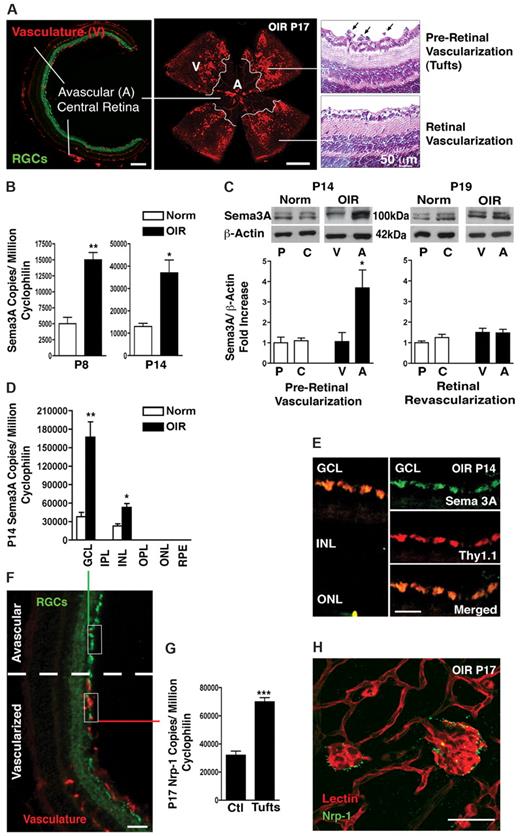 Figure 1. Sema3A expression is consistent with a role in retinopathy. (A) Frozen cross-section (left panel) and flat-mount retinas (central panel) taken at P17 of OIR demonstrating the principal characteristics of PRs including avascular (A) and vascular (V) zones. Paraffin sections (right panel) demonstrating pre-retinal neovascular tufts (black arrows). (B) Real-time PCR on whole retinas taken at P8 and P14 demonstrates an ∼ 3-fold increase in Sema3A during the vaso-obliterative and neovascular phases of PRs, respectively (n = 3). Values are gene copy number normalized to CyclophilinA standards ± SEM. **P = .0015 and *P = .0157 compared with normoxia (Norm). (C) Microdissection of avascular regions of the OIR retina at P14 reveals a 3.5-fold induction in Sema3A protein levels in the avascular area (n = 3). Values are shown relative to vascularized areas ± SEM. *P = .0447 compared with the vascularized zone (V). At P19, when physiologic retinal revascularization is reinstated, Sema3A in the avascular retina returns to control levels. Levels of Sema3A in the peripheral (P) and central (C) retina of normoxic controls are comparable. (D) Laser capture microdissection on retinal layers (F) (also see supplemental Figure 1B) demonstrates that Sema3A is primarily produced in the ganglion cell layer (GCL), with lower expression in the inner nuclear layer (INL). ONL indicates outer nuclear layer. Levels of Sema3A surge 4.4-fold in the GCL at P14 after OIR (n = 3). **P = .0075 and *P = .0143 relative to normoxia (Norm). (E) Confocal imaging of immunohistochemistry on central avascular retinal cross-sections (OIR P14) reveals a predominant expression of Sema3A by RGCs as confirmed by merging with RGC marker Thy1.1. (G) At P17, laser capture microdissection and RT-PCR of normal vessels versus neovascular tufts revealed a 2.2-fold induction in Nrp-1 in tufts (n = 3). Values are gene copy number normalized to CyclophilinA standards ± SEM. ***P = .0007 compared with controls (Ctl). (H) Immunohistochemistry on flat-mount retinas confirms pronounced staining of Nrp-1 on lectin-stained neovascular tufts (P17). Images are representative of 5 experiments. Scale bars represent 300 μm (A right panel), 500 μm (A central panel), 50 μm (A right panel) 25 μm (E), 100 μm (F), and 25 μm (H).