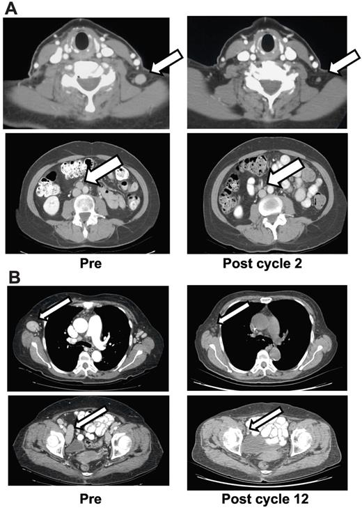 Figure 1. Patient responses. (A) Patient had recurrent PTCL, subtype not otherwise specified (NOS) after cyclophosphamide, doxorubicin, vincristine, and prednisone (CHOP); etoposide, methylprednisolone, cytarabine, and cisplatin (ESHAP); and autologous stem cell transplant. PET scan at 8 months showed no evidence of disease. The response was scored as CR and therapy was discontinued after 2 years with the patient remaining free of disease for another 53 months. (B) Patient with PTCL, subtype not otherwise specified (NOS), had prior CHOP and pralatrexate. Patient, who was declared a PR after 2 cycles of romidepsin and a CR afer 12 cycles of romidepsin, remained on study at 24 months as of data cutoff.