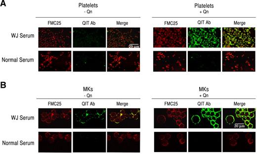 Figure 3. QITP antibodies bind mature Mks. Human platelets (A) and Mks (B) were incubated with QITP sera or NS without (left panels) and with Qn (right panels) and the anti-GPIX monoclonal antibody FMC25, followed by anti-human IgG–Alexa Fluor 488 (green) and anti-mouse IgG (H+L)–Alexa Fluor 594 (red). Binding of human IgG (green) was considerably enhanced only in the presence of the drug (right panels, middle image). The microphotographs were acquired by confocal laser scanning microscopy (Olympus FV300, 60× oil objective, Fluoview Version 4.3 software). Scale bars indicate 20 μm. Images were cropped and revised using Adobe Photoshop CS5.